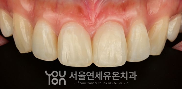 블랙트라이앵글을 메운 뒤의 앞니