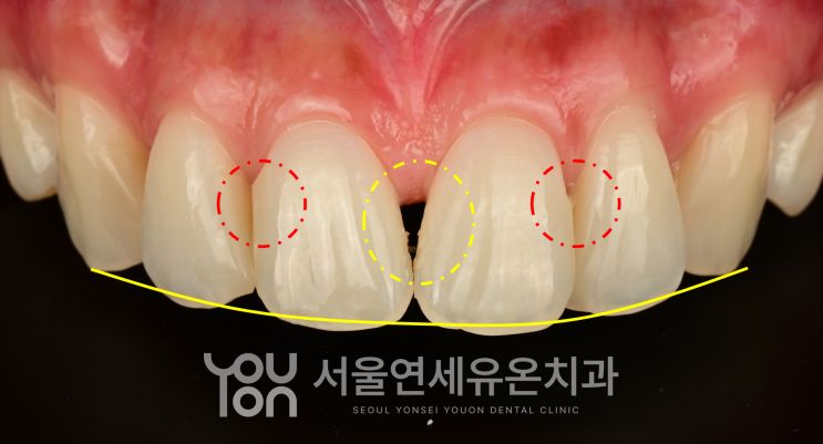 블랙트라이앵글, 기존 레진, 스마일라인을 표시한 분석 사진