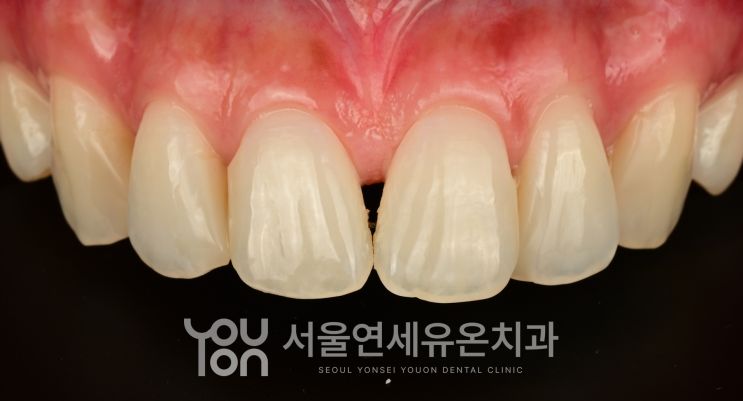 교정 후 앞니 사이에 블랙트라이앵글이 보이는 치료 전 모습