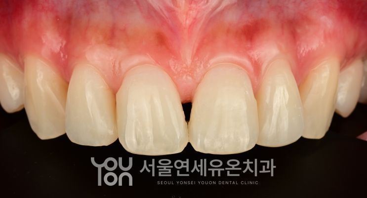 치아 끝 라인을 정리한 뒤의 앞니