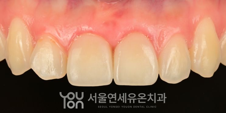 PFZ 크라운으로 재치료한 뒤의 앞니