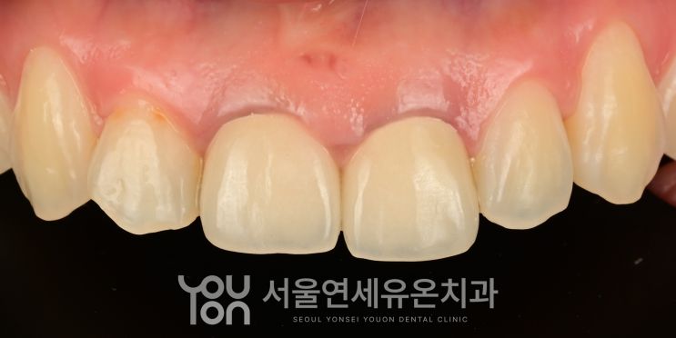 잇몸이 검게 비치고 짧아 보이는 기존 앞니 크라운