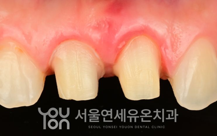 실활치 미백 후 밝아진 안쪽 치아