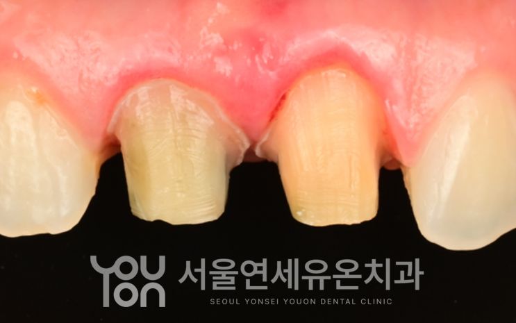 기존 크라운을 제거한 뒤 확인한 안쪽 치아의 변색