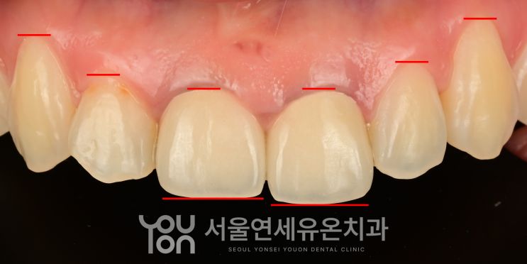 치아 끝과 잇몸 높이를 표시한 분석 사진