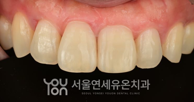 바이오클리어 레진으로 공간을 닫은 치료 후
