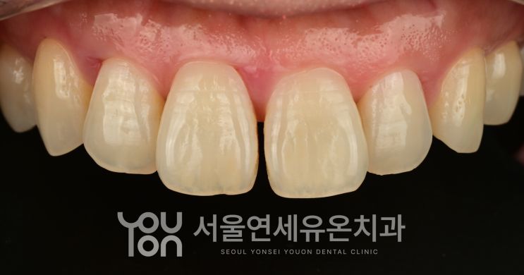 가운데 앞니 사이가 벌어진 치료 전 모습