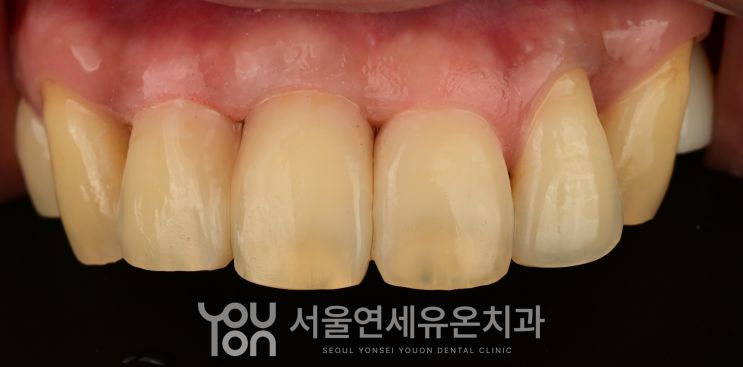 레진 빌드업으로 축과 공간을 회복한 앞니