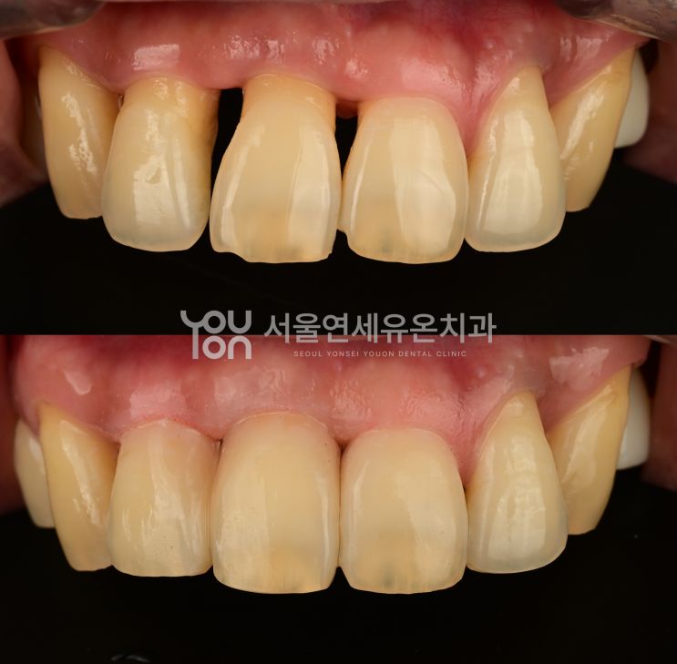 잇몸질환으로 벌어진 앞니의 레진 빌드업 전후 비교