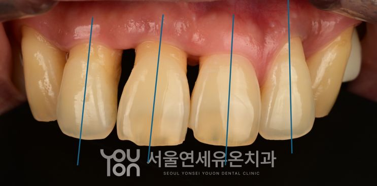 각 치아의 축을 분석해 최종 형태를 계획한 사진