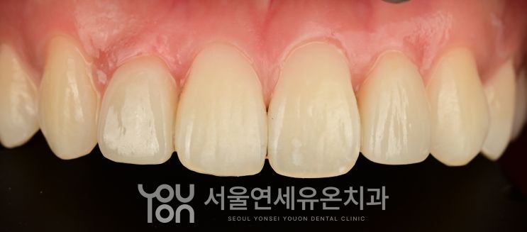 옆 앞니 라미네이트 후 자연스러워진 앞니