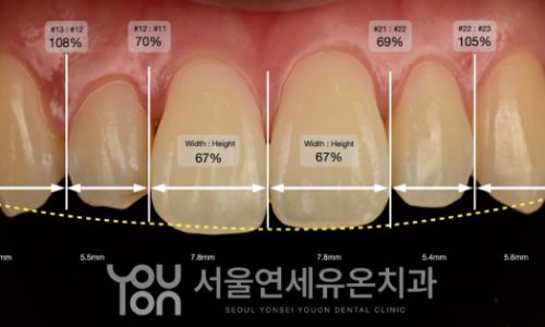 치아별 폭과 길이 비율을 측정한 분석 사진