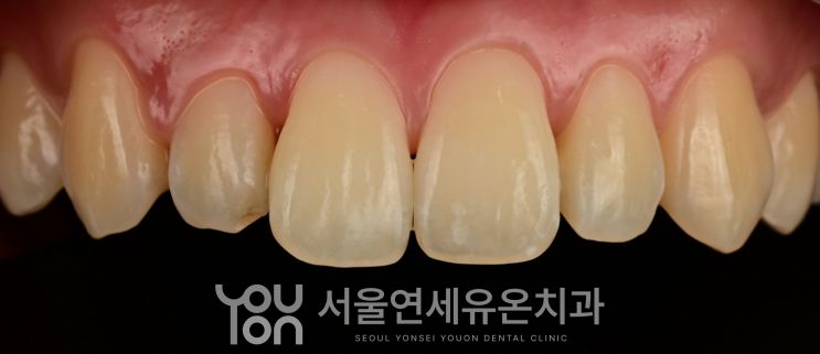 양쪽 옆 앞니가 작아 보이는 치료 전 모습