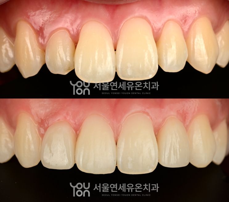 작은 옆 앞니 라미네이트 치료 전후 비교