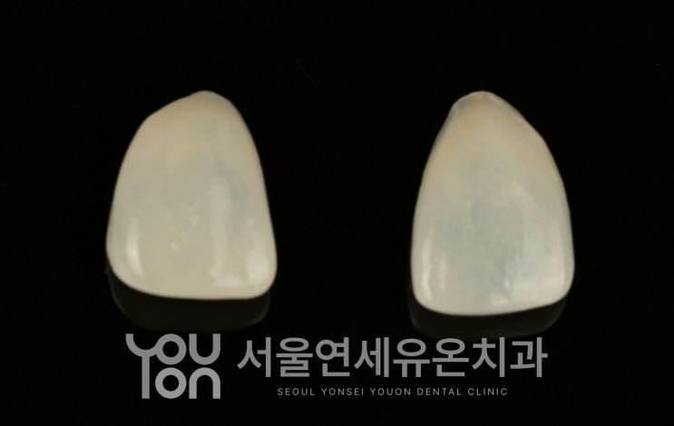 제작된 옆 앞니 라미네이트 두 개